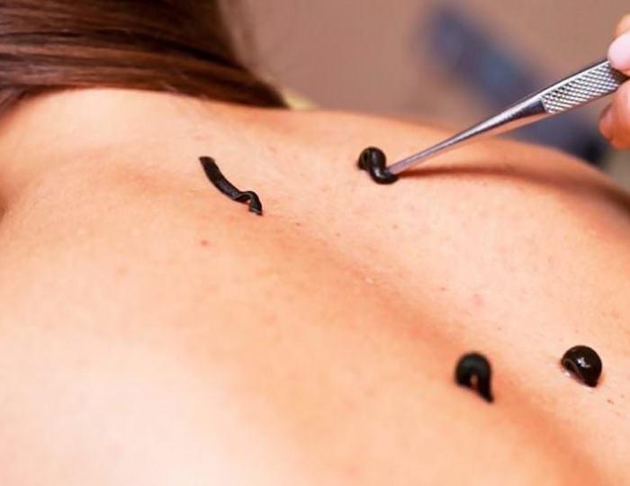 Гирудотерапия - Оздоровительные услуги - Санаторий «Юность» Беларусь